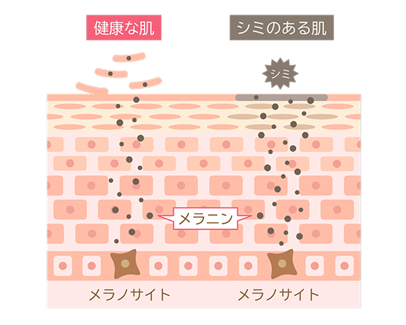 健康な肌とシミのある肌の図